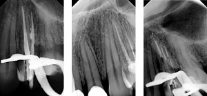 Dental Medicenter - dodatkowy-kanał-w-trakcie-przed i po