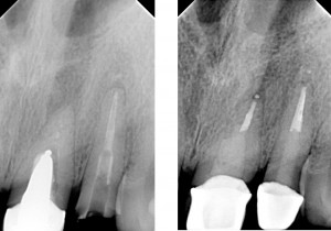 Dental Medicenter - usunięcie-wkładu-przed i po