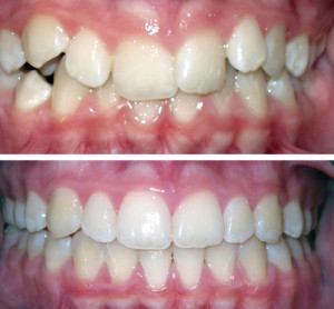 Leczenie ortodontyczne Zębów